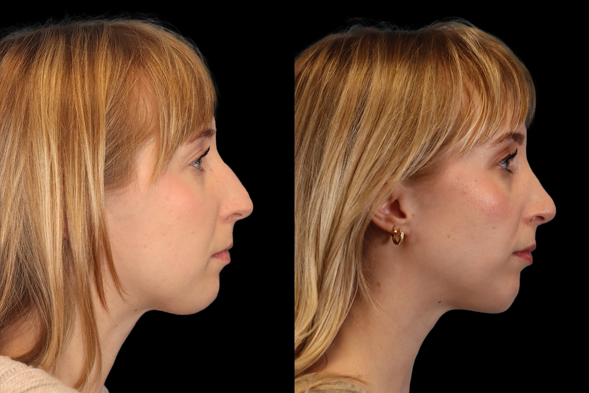 Nose Before and After | Leong Facial Plastic Surgery