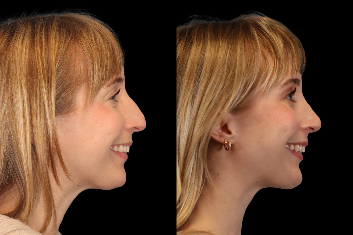 Nose Before and After | Leong Facial Plastic Surgery