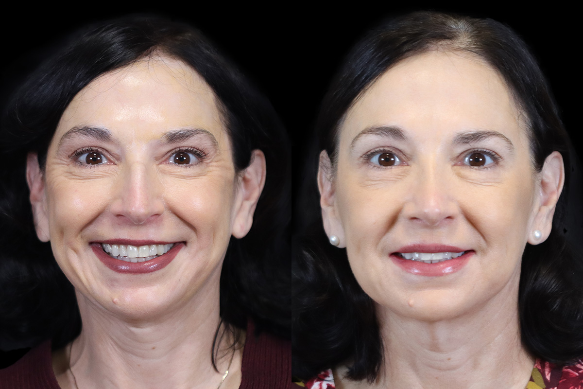 Nose Before and After | Leong Facial Plastic Surgery