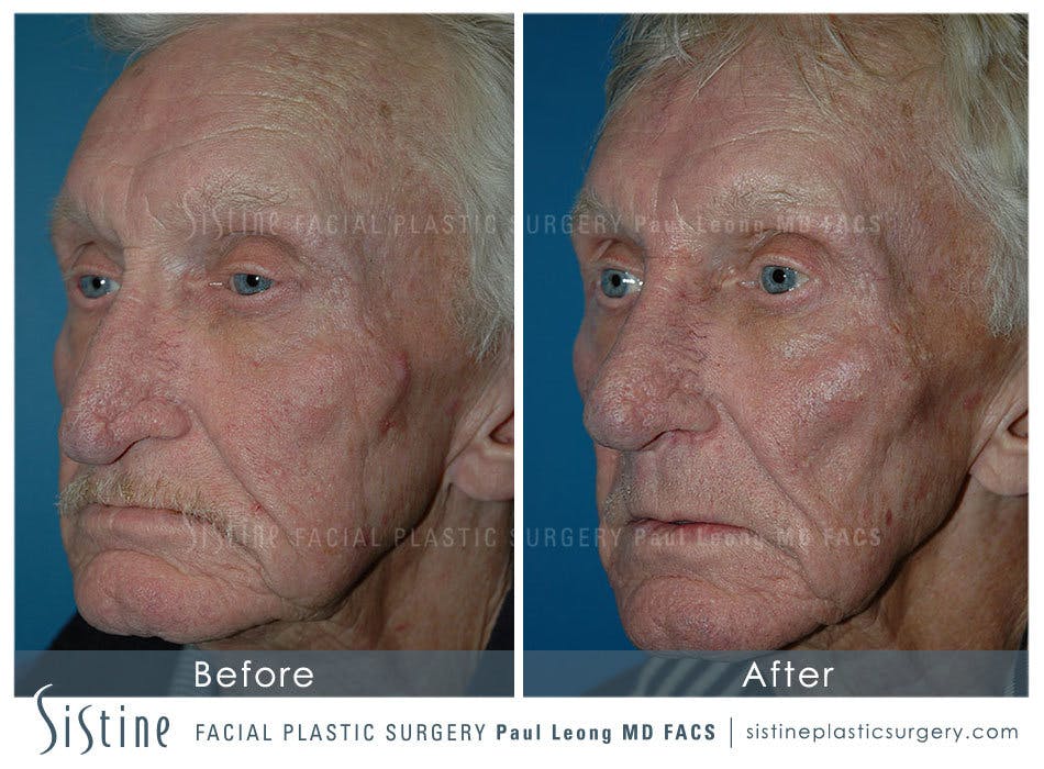 Nose Before and After | Leong Facial Plastic Surgery