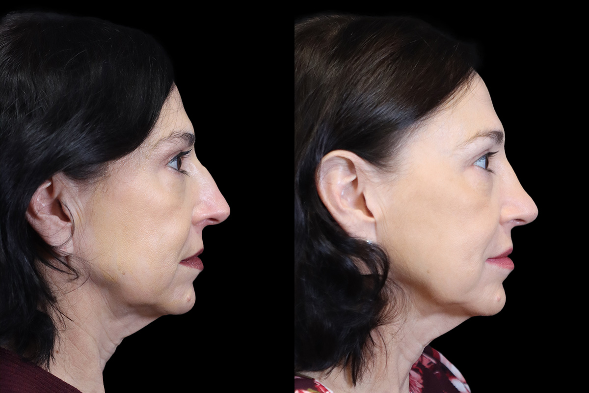 Nose Before and After | Leong Facial Plastic Surgery