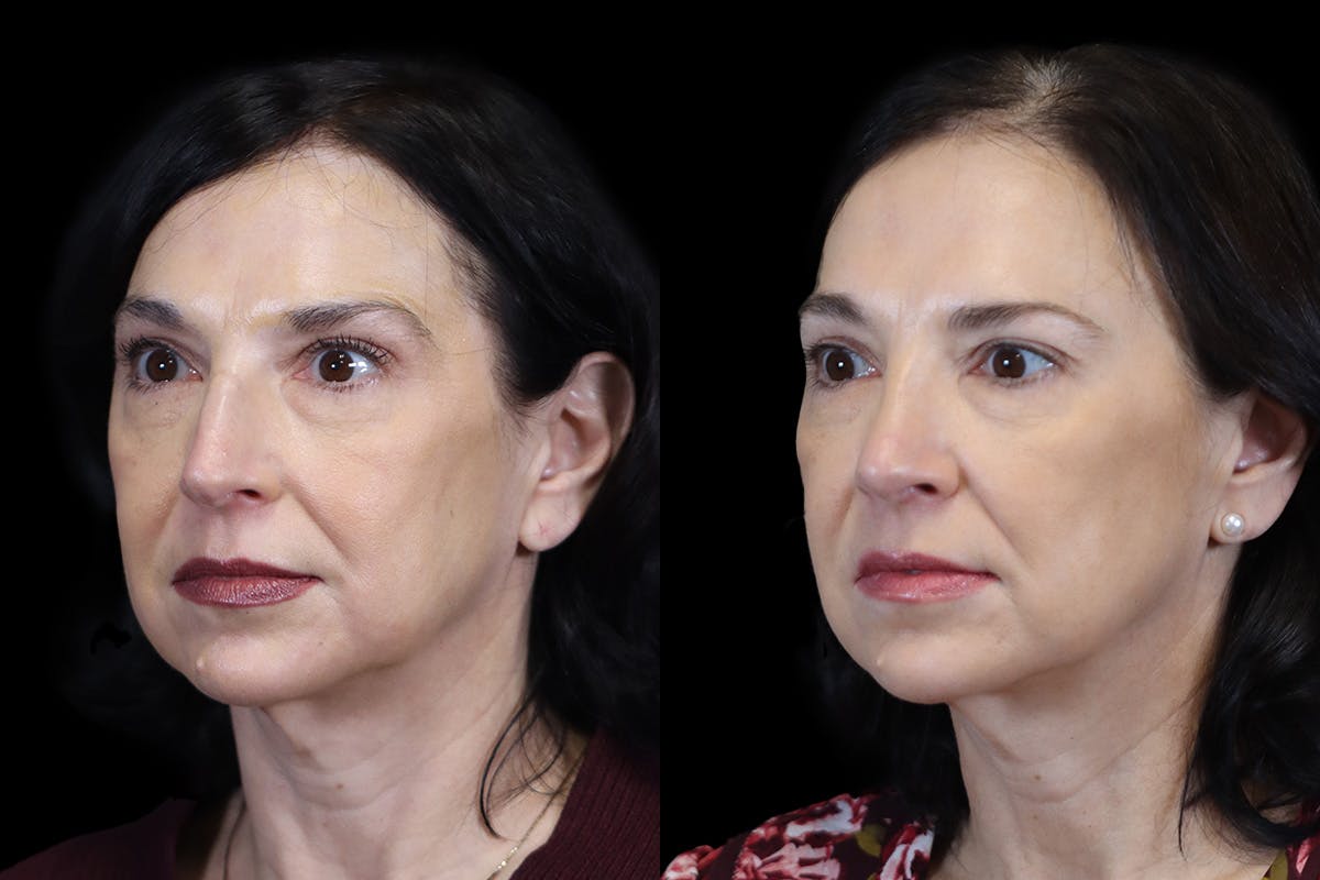 Nose Before and After | Leong Facial Plastic Surgery