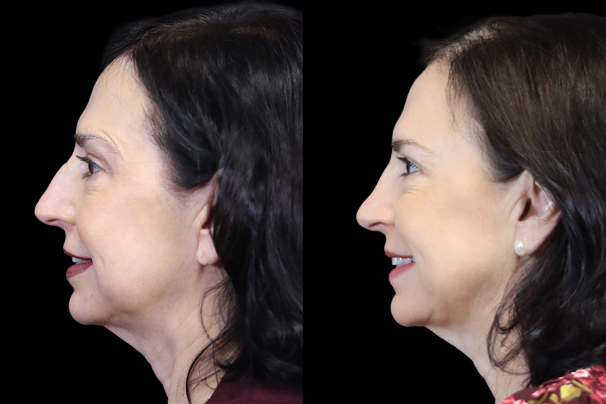 Nose Before and After | Leong Facial Plastic Surgery