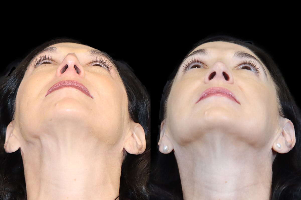 Nose Before and After | Leong Facial Plastic Surgery