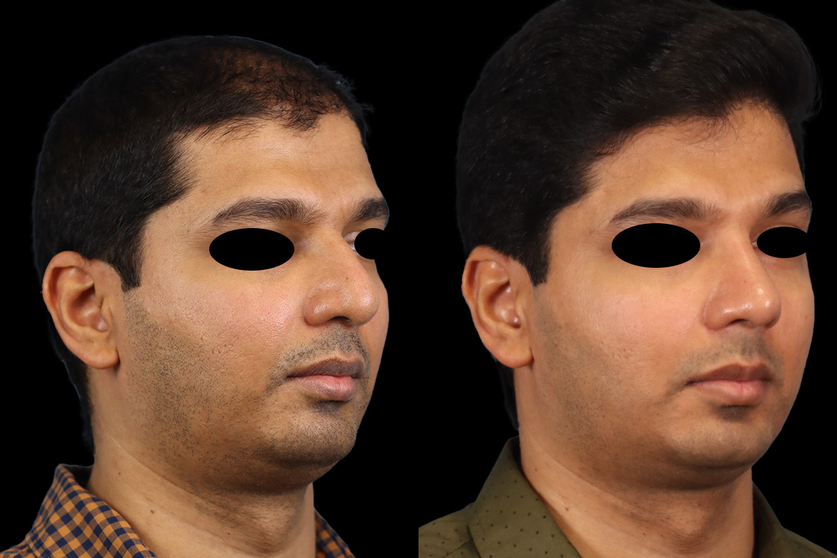 Nose Before and After | Leong Facial Plastic Surgery