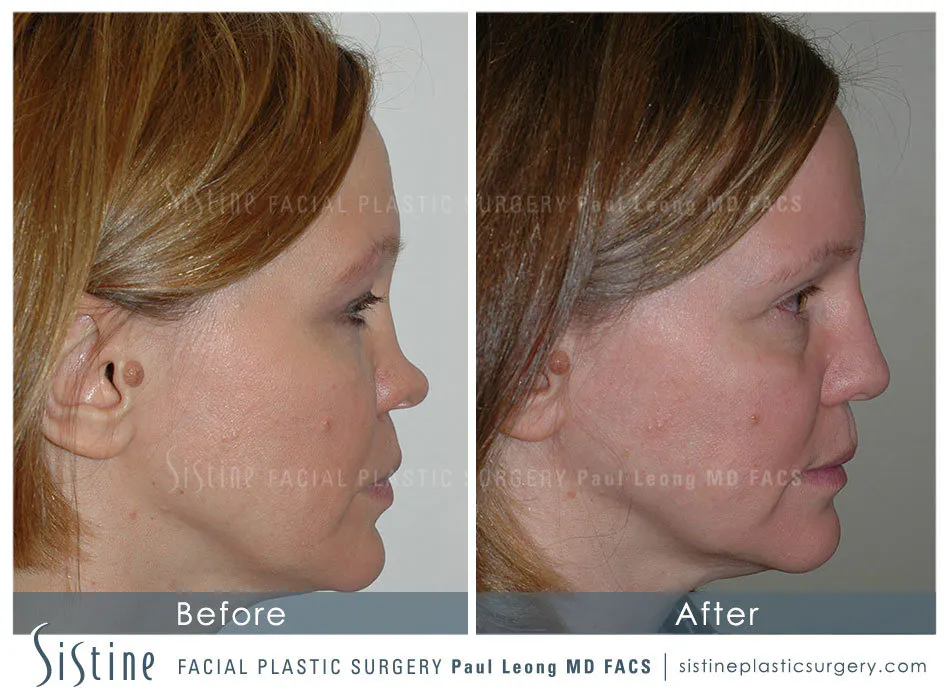 Nose Before and After | Leong Facial Plastic Surgery