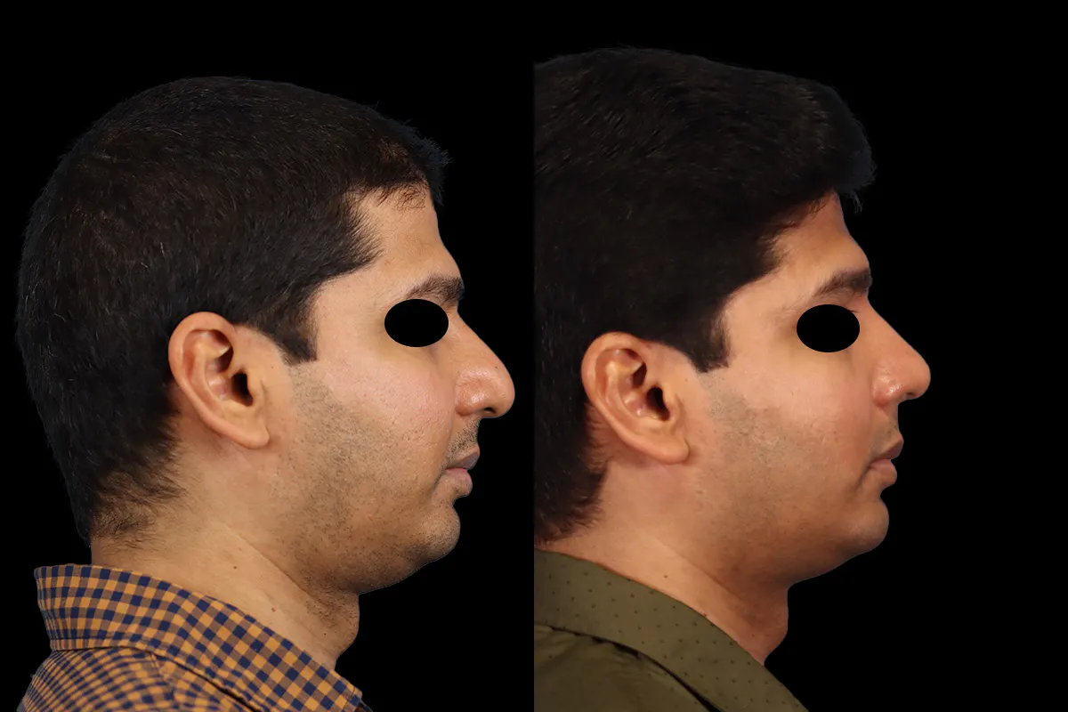 Nose Before and After | Leong Facial Plastic Surgery