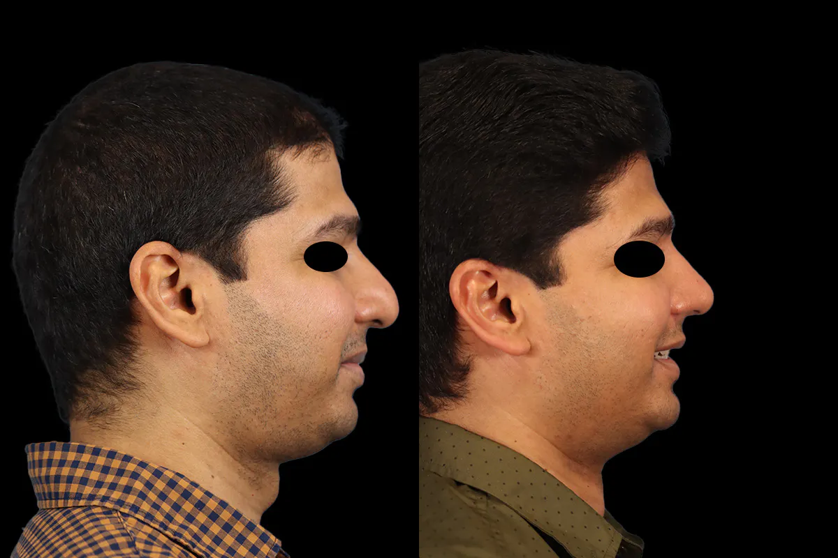 Nose Before and After | Leong Facial Plastic Surgery