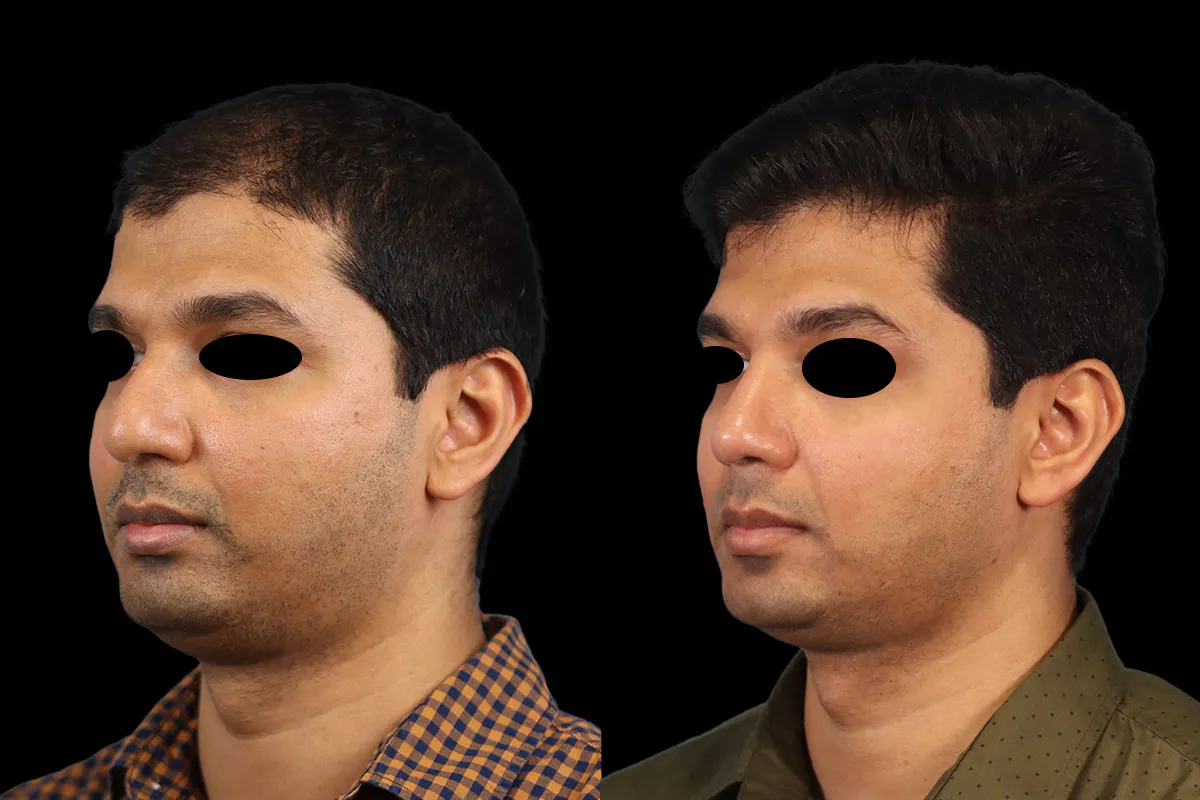 Nose Before and After | Leong Facial Plastic Surgery