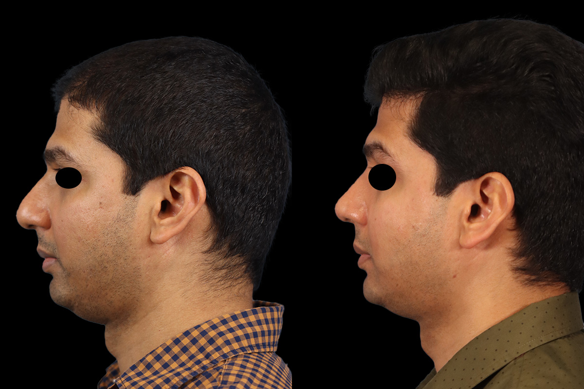 Nose Before and After | Leong Facial Plastic Surgery