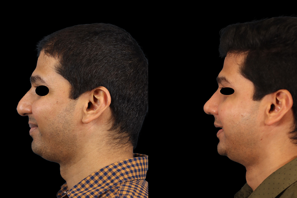 Nose Before and After | Leong Facial Plastic Surgery