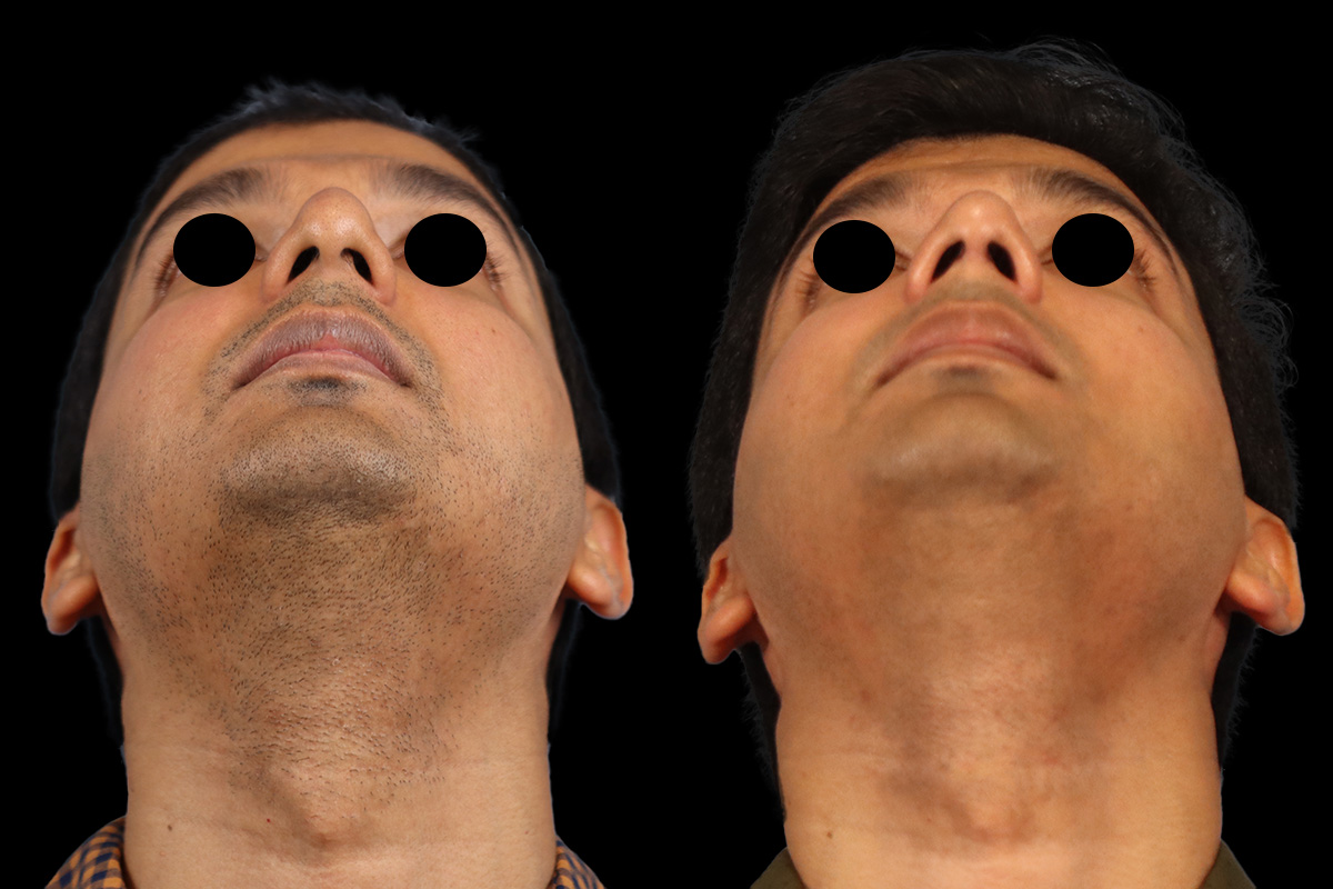 Nose Before and After | Leong Facial Plastic Surgery