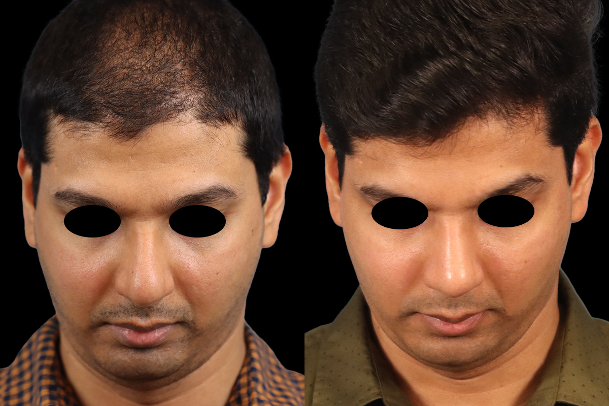 Nose Before and After | Leong Facial Plastic Surgery