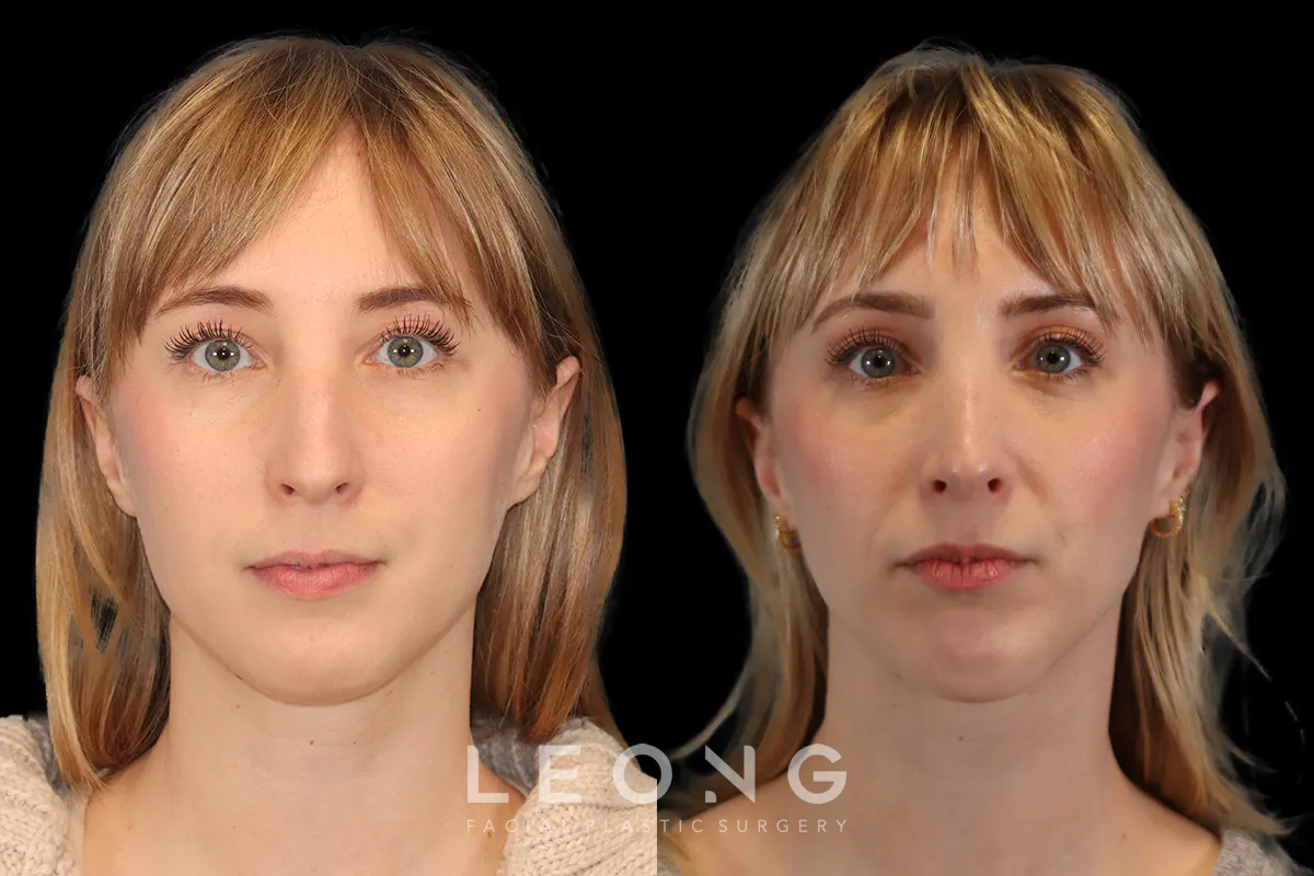 Nose Before and After | Leong Facial Plastic Surgery