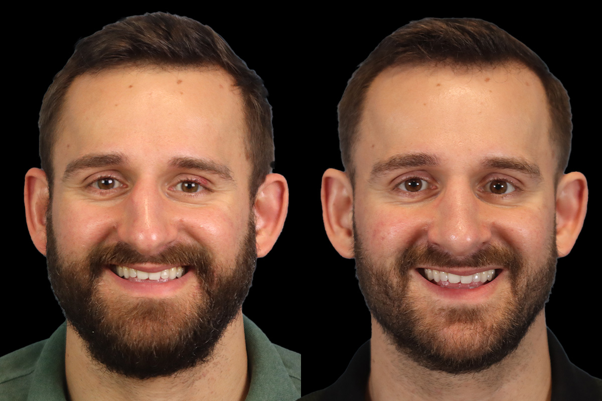 Nose Before and After | Leong Facial Plastic Surgery