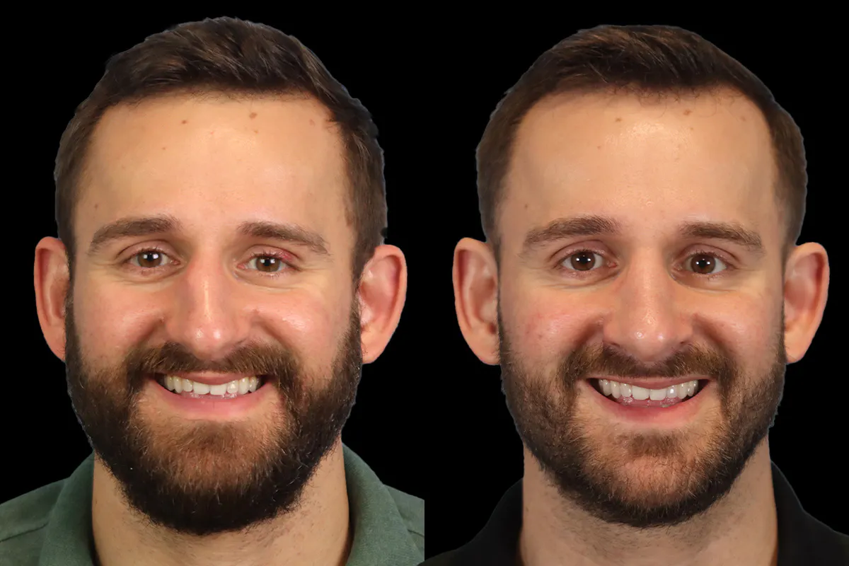 Nose Before and After | Leong Facial Plastic Surgery