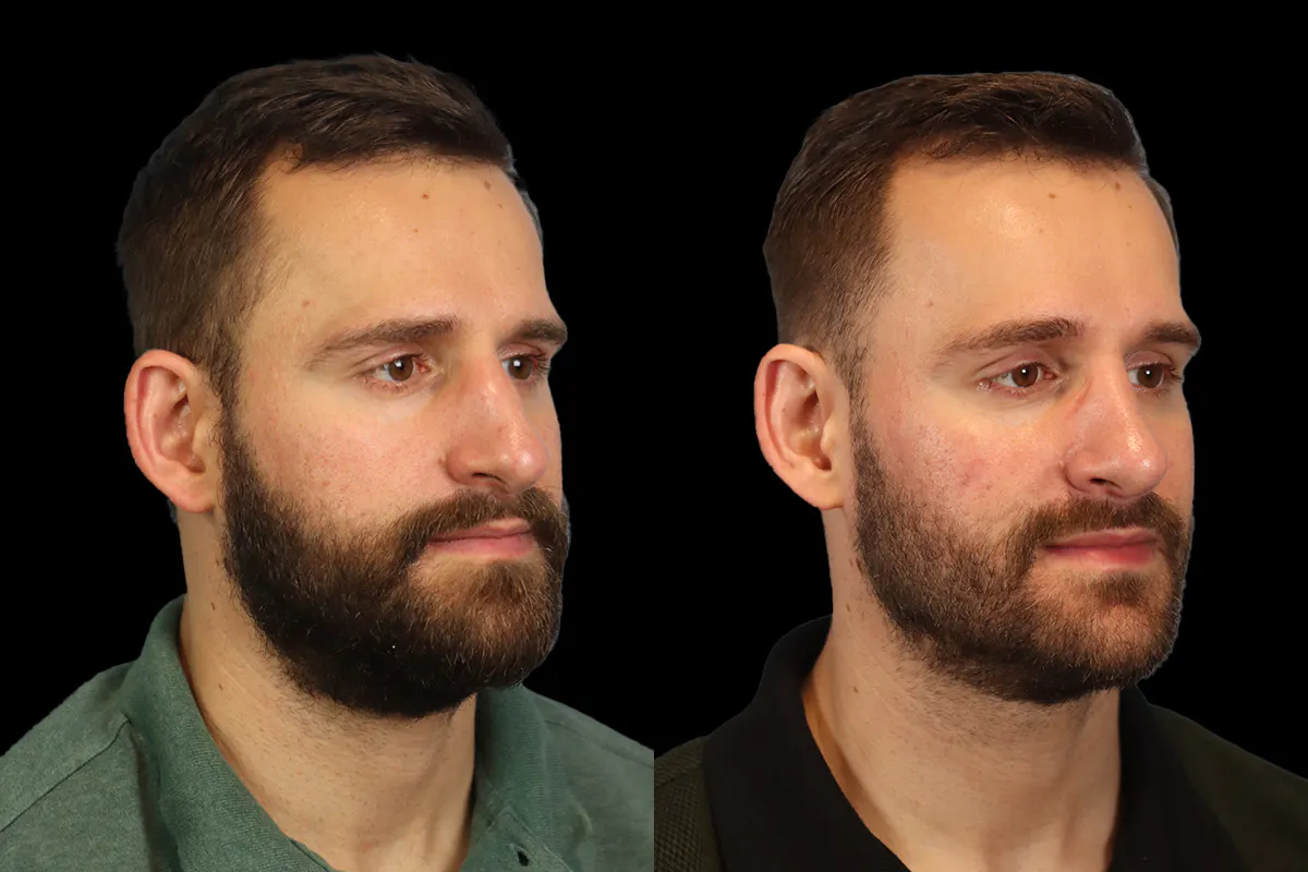 Nose Before and After | Leong Facial Plastic Surgery