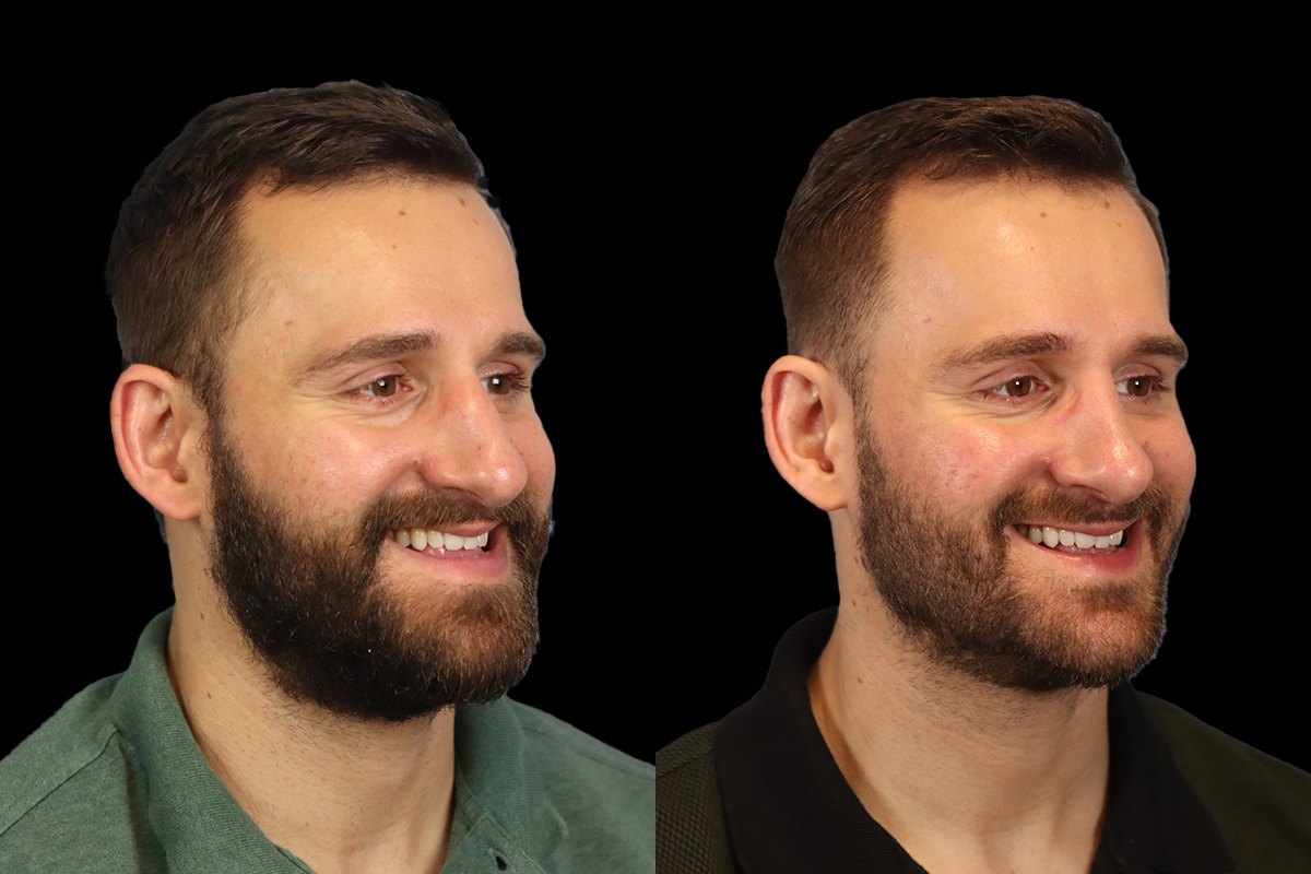 Nose Before and After | Leong Facial Plastic Surgery