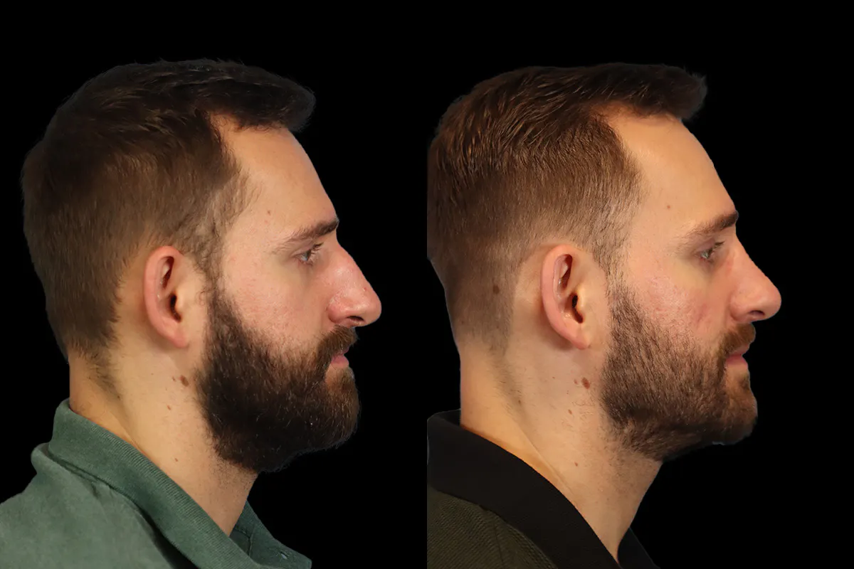 Nose Before and After | Leong Facial Plastic Surgery