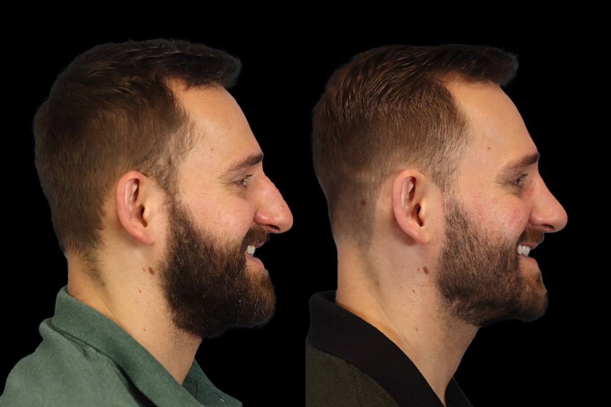 Nose Before and After | Leong Facial Plastic Surgery