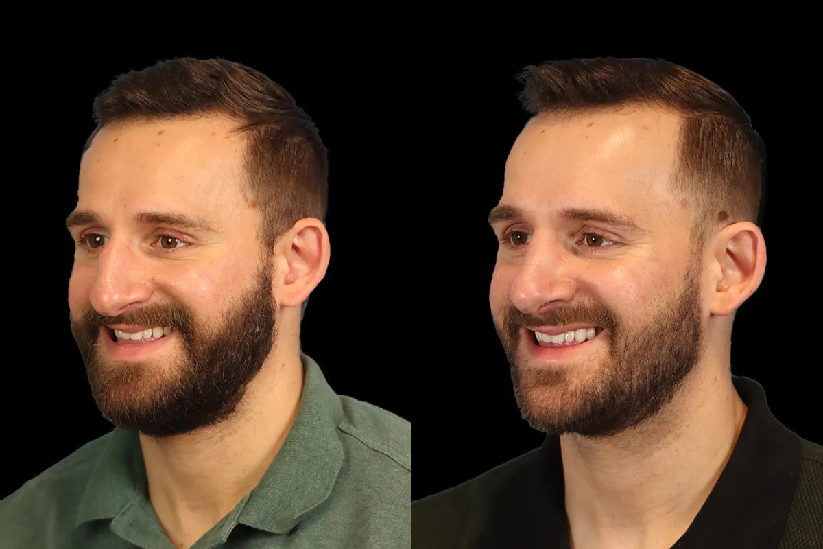 Nose Before and After | Leong Facial Plastic Surgery