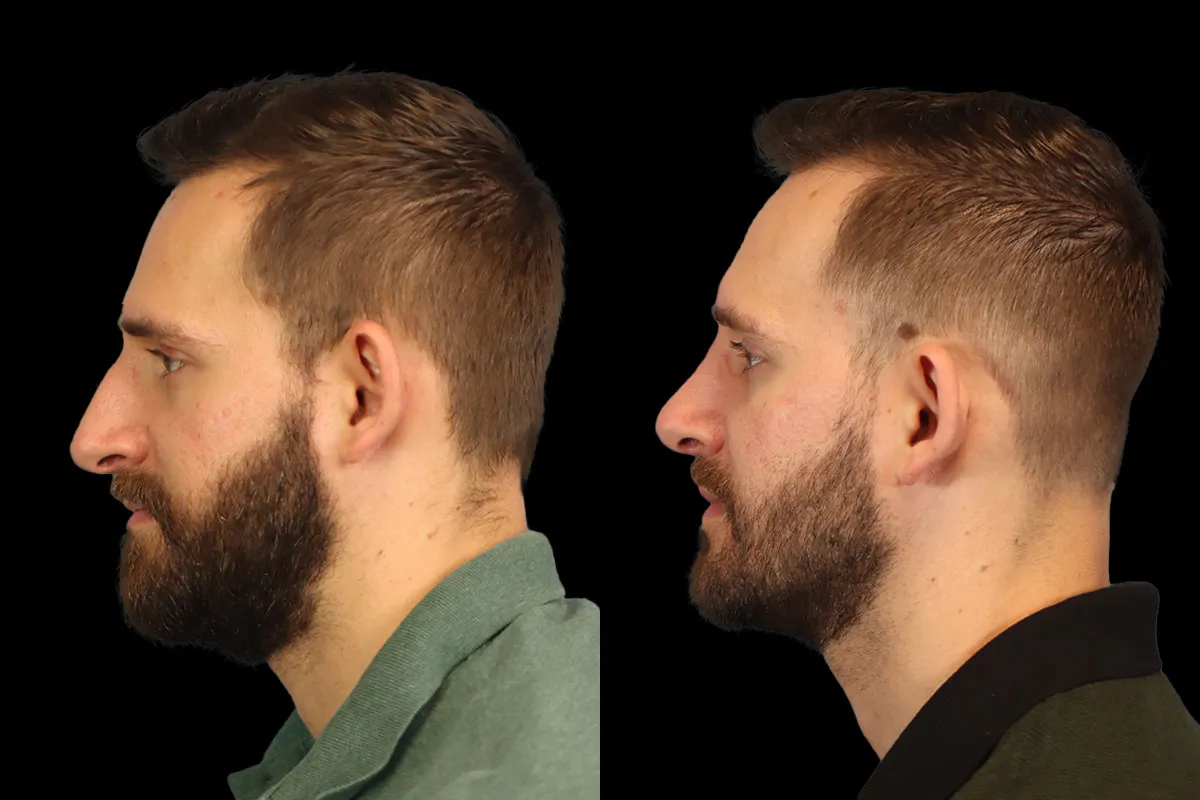 Nose Before and After | Leong Facial Plastic Surgery