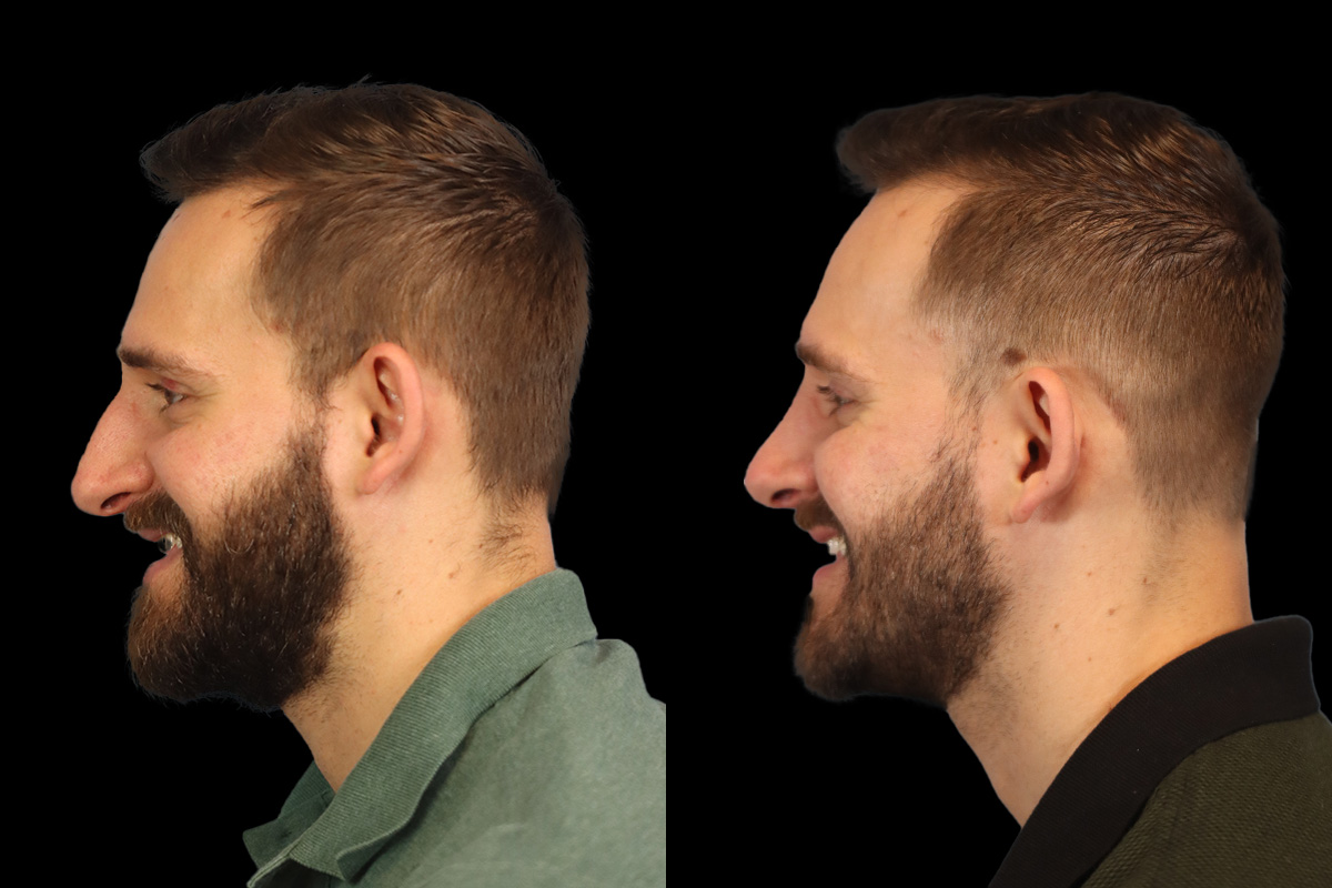 Nose Before and After | Leong Facial Plastic Surgery