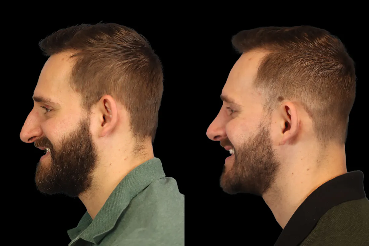 Nose Before and After | Leong Facial Plastic Surgery