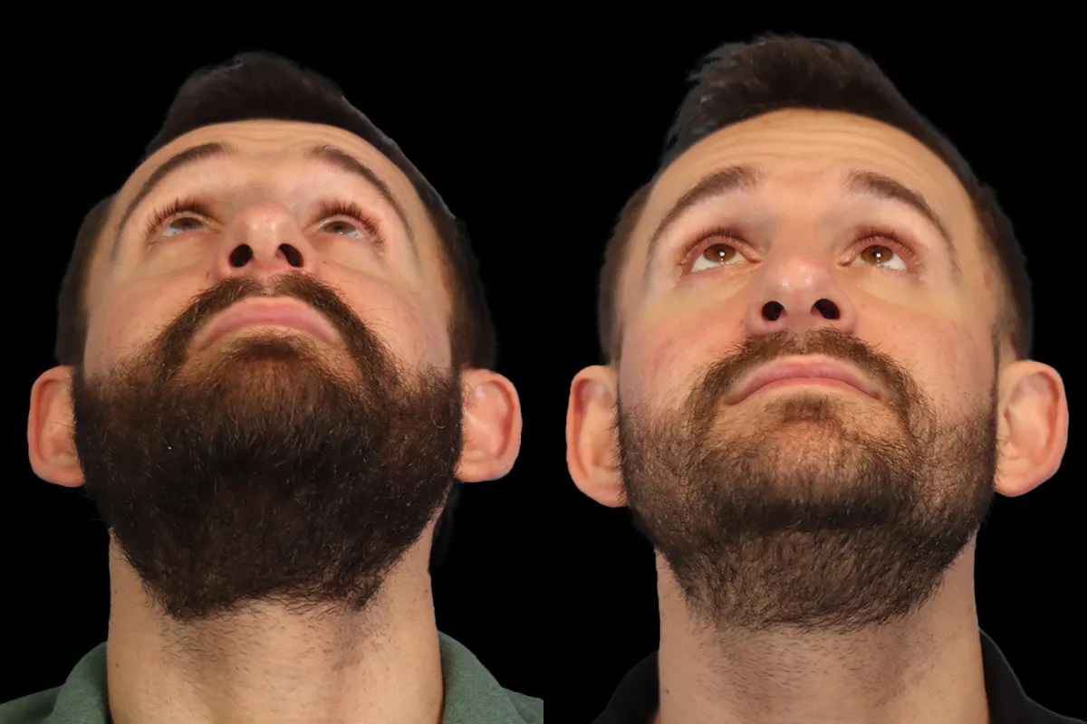 Nose Before and After | Leong Facial Plastic Surgery