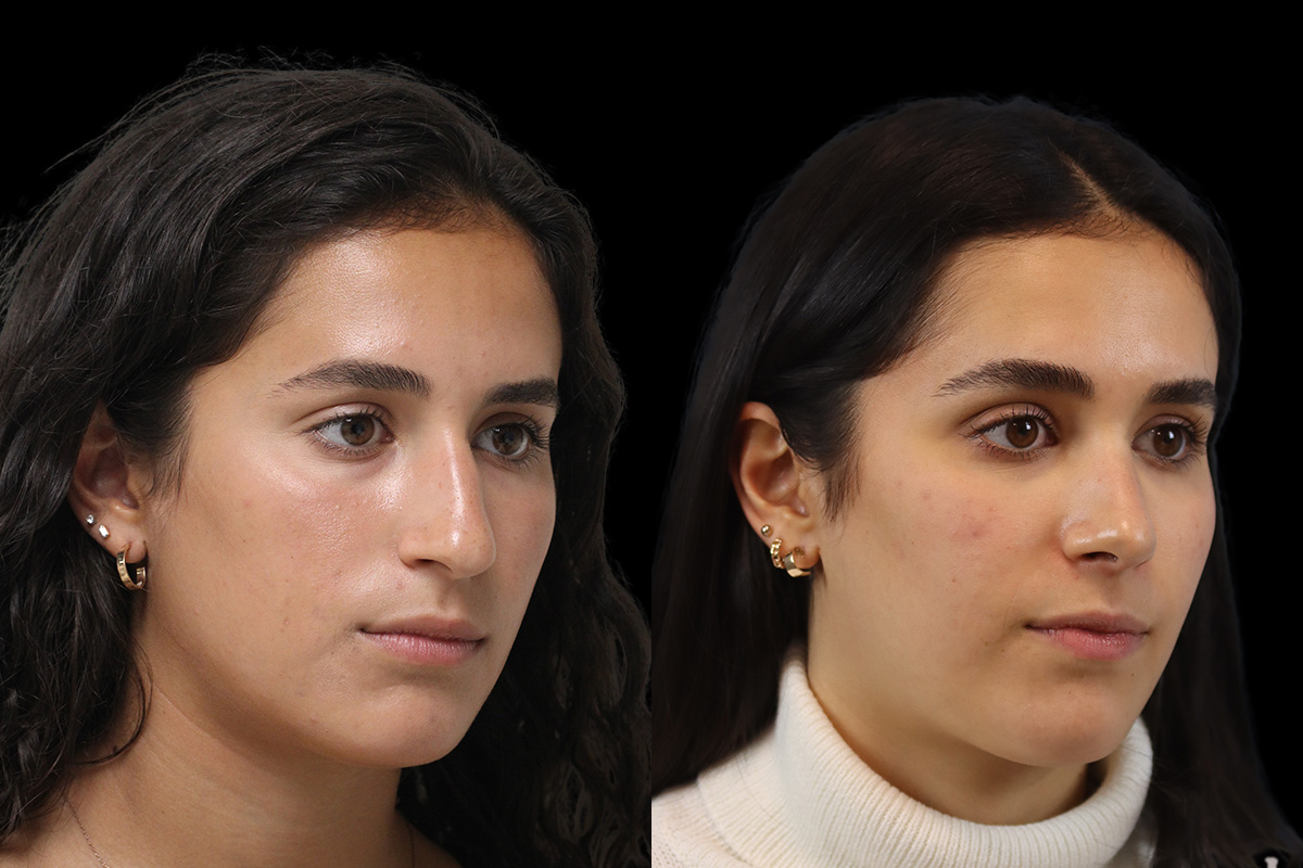 Nose Before and After | Leong Facial Plastic Surgery