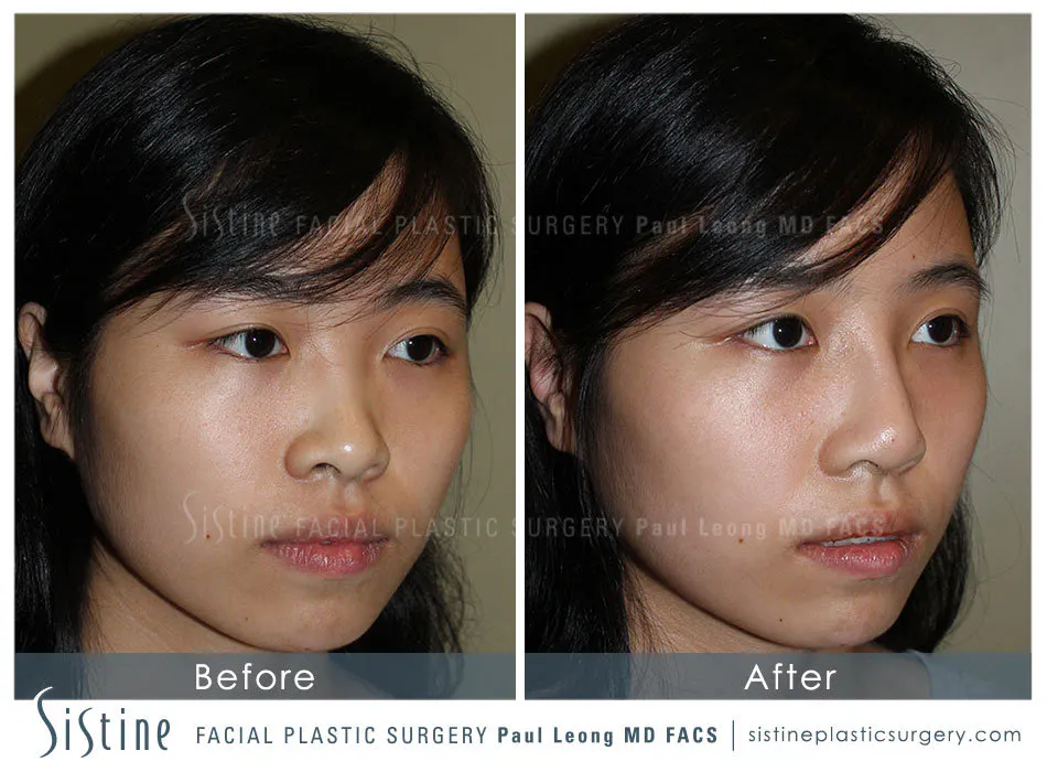 Nose Before and After | Leong Facial Plastic Surgery
