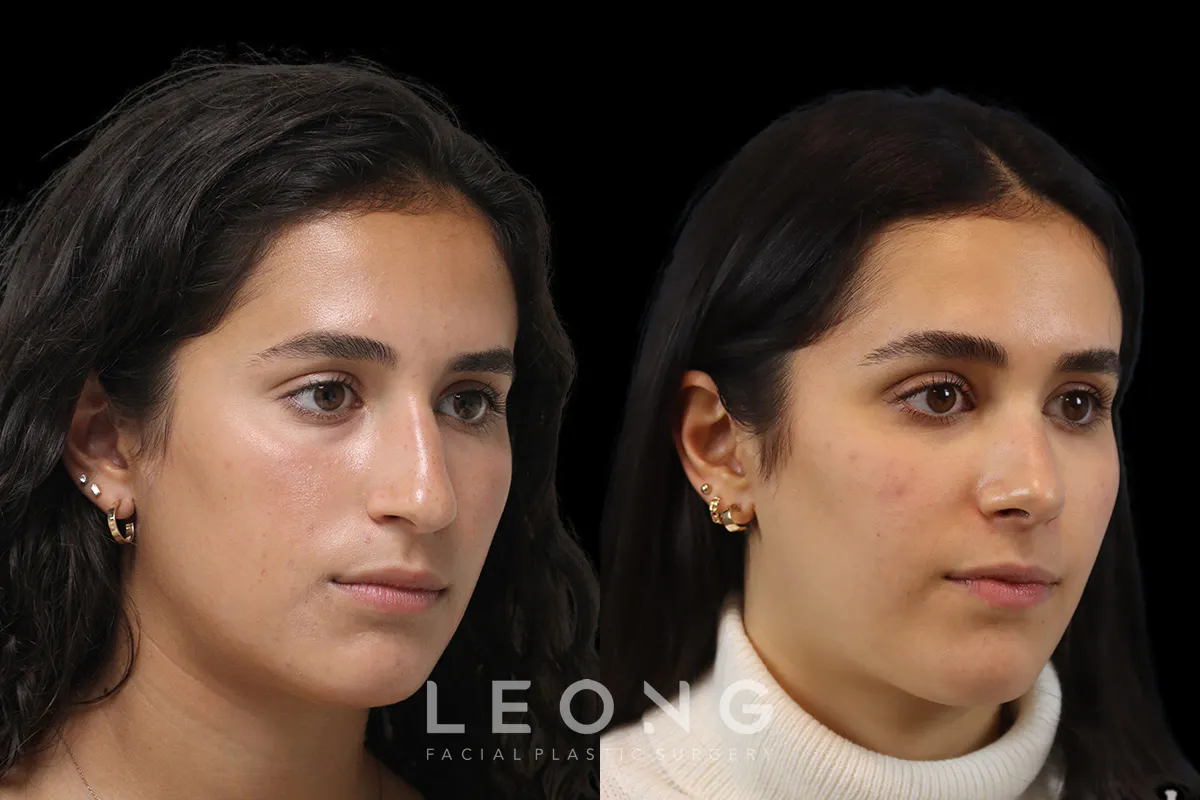 Nose Before and After | Leong Facial Plastic Surgery