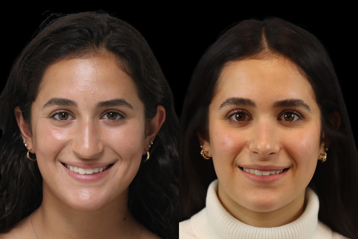 Nose Before and After | Leong Facial Plastic Surgery