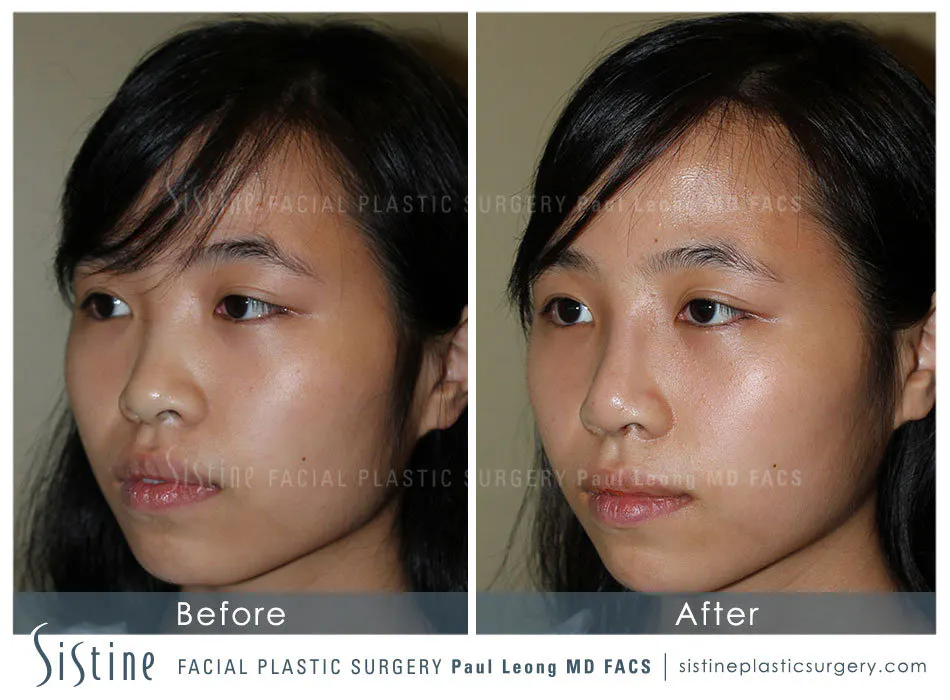 Nose Before and After | Leong Facial Plastic Surgery