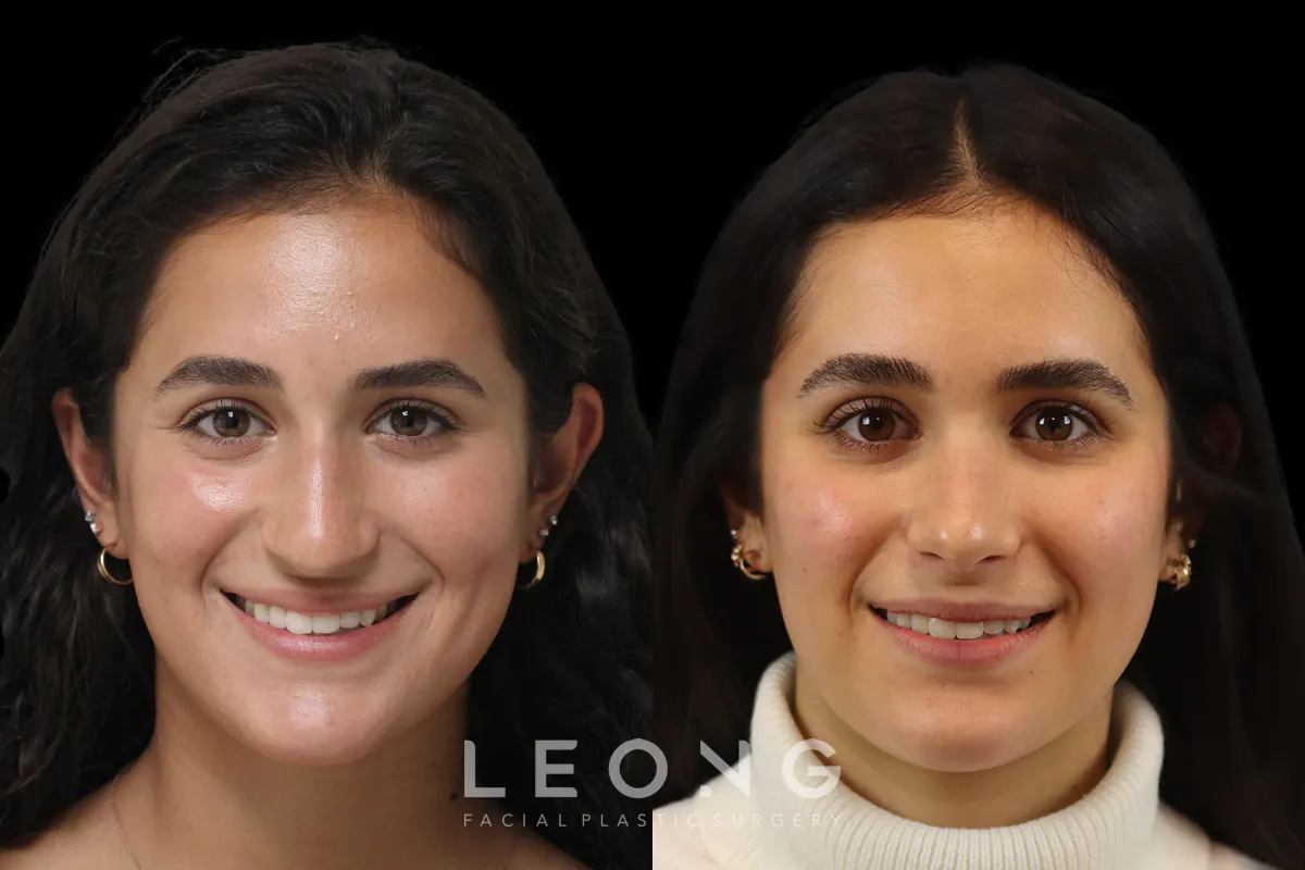 Nose Before and After | Leong Facial Plastic Surgery