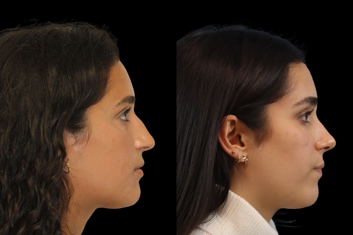 Nose Before and After | Leong Facial Plastic Surgery