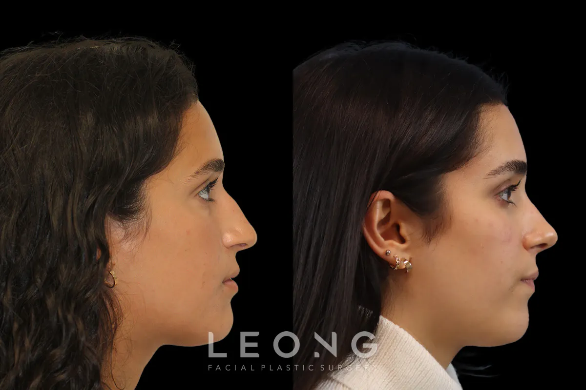 Nose Before and After | Leong Facial Plastic Surgery