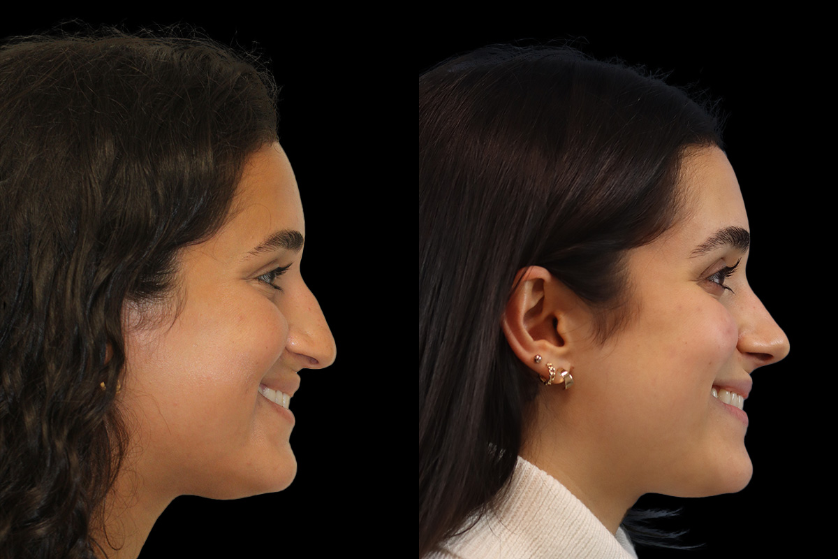 Nose Before and After | Leong Facial Plastic Surgery