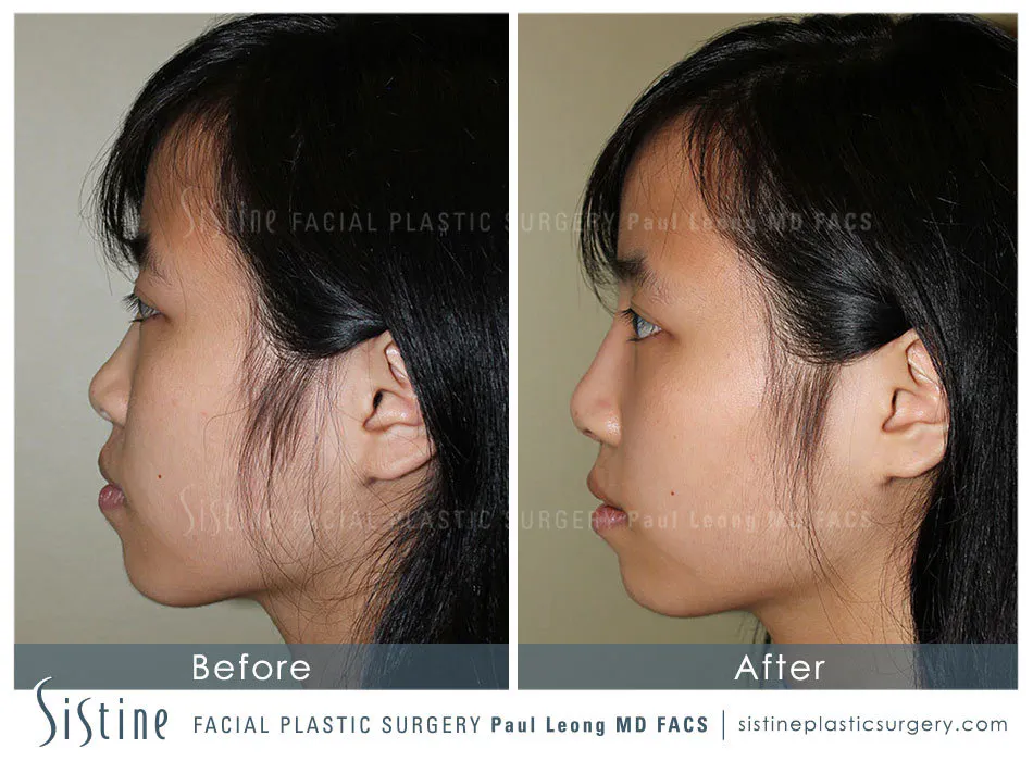 Nose Before and After | Leong Facial Plastic Surgery