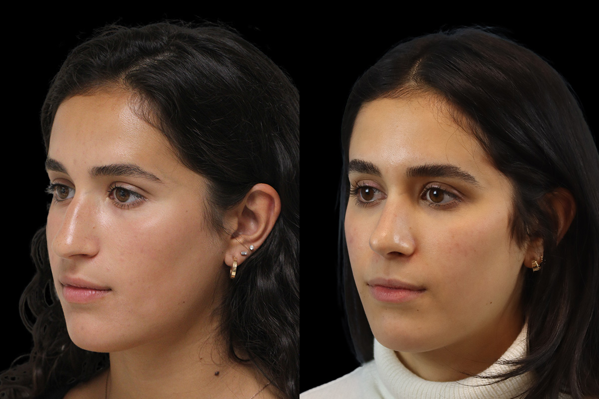 Nose Before and After | Leong Facial Plastic Surgery