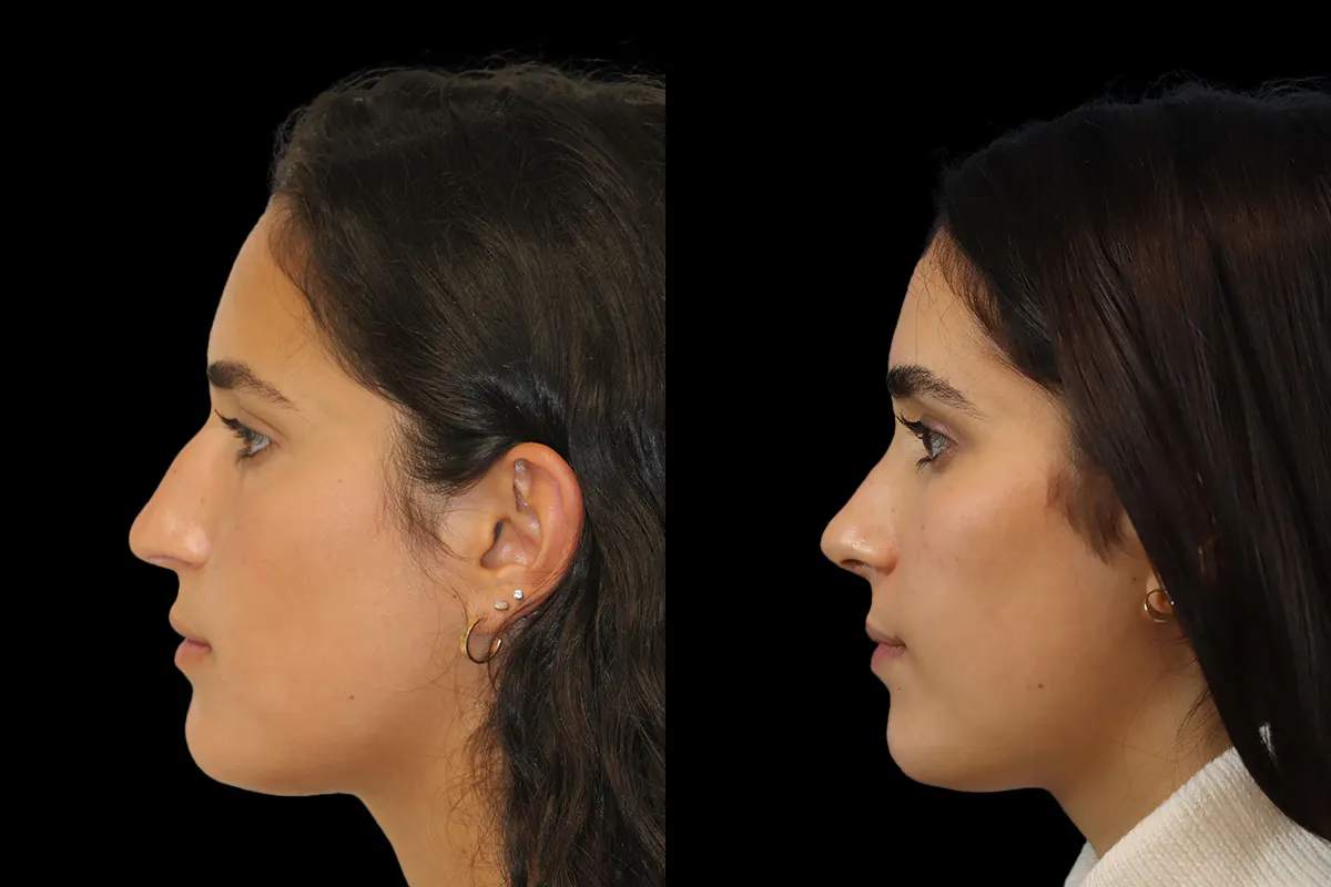 Nose Before and After | Leong Facial Plastic Surgery