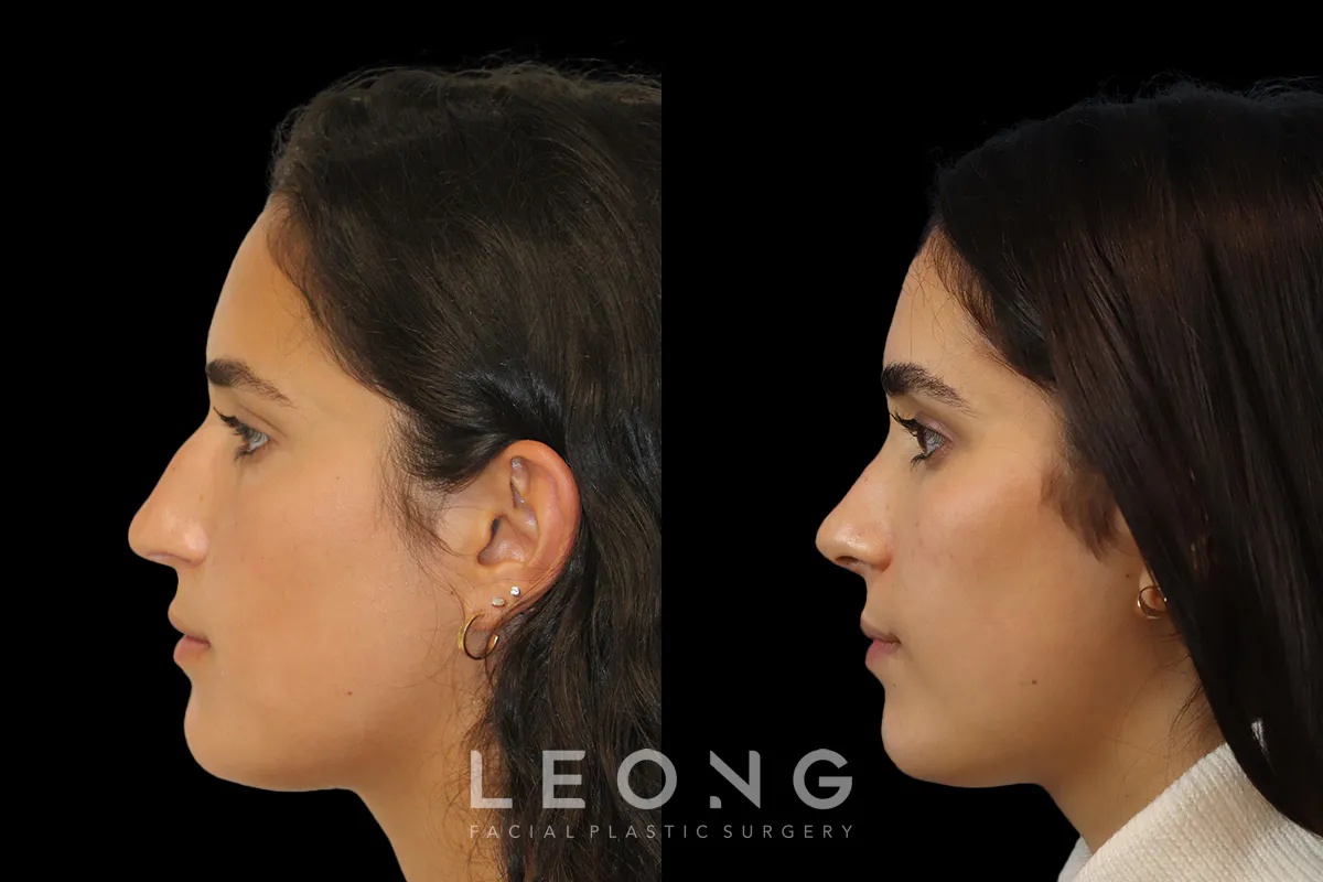 Nose Before and After | Leong Facial Plastic Surgery