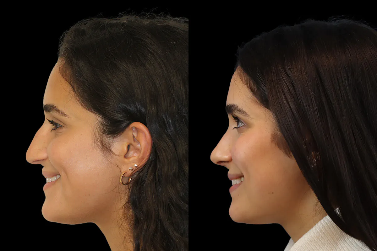 Nose Before and After | Leong Facial Plastic Surgery