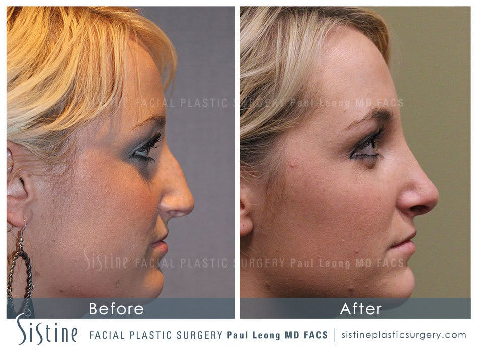 Nose Before and After | Leong Facial Plastic Surgery