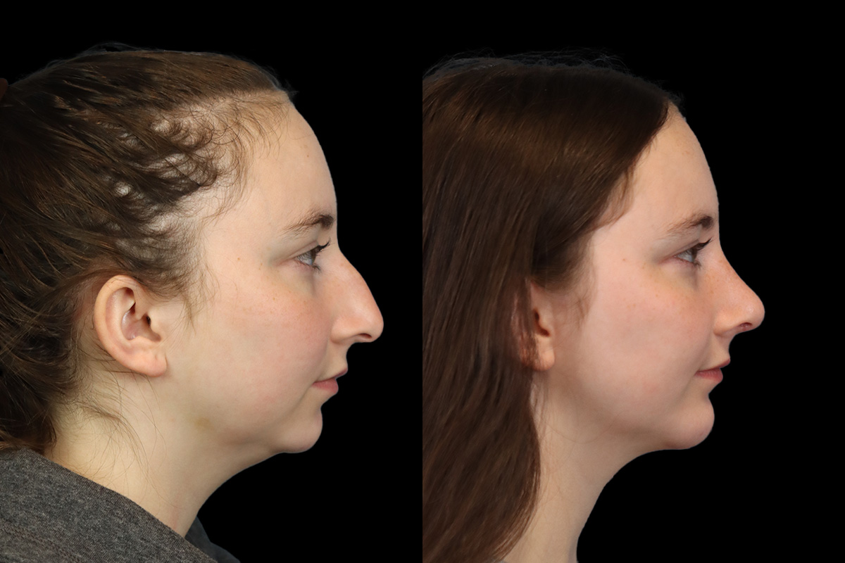 Nose Before and After | Leong Facial Plastic Surgery