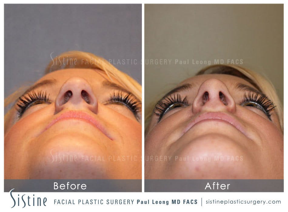 Nose Before and After | Leong Facial Plastic Surgery