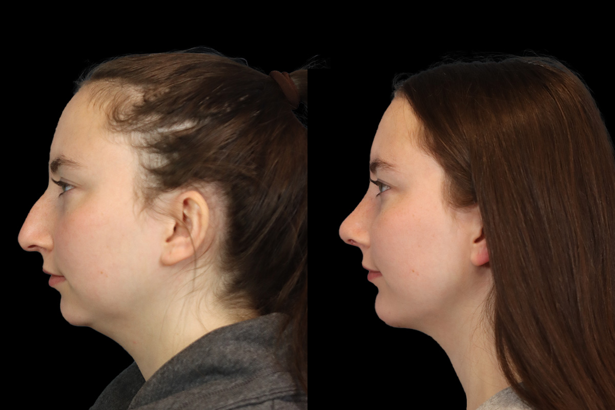 Nose Before and After | Leong Facial Plastic Surgery