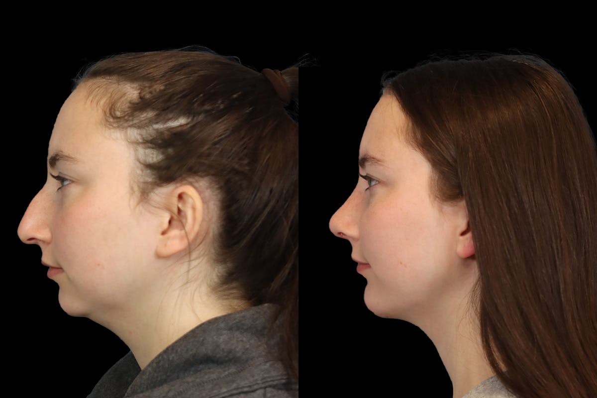 Nose Before and After | Leong Facial Plastic Surgery