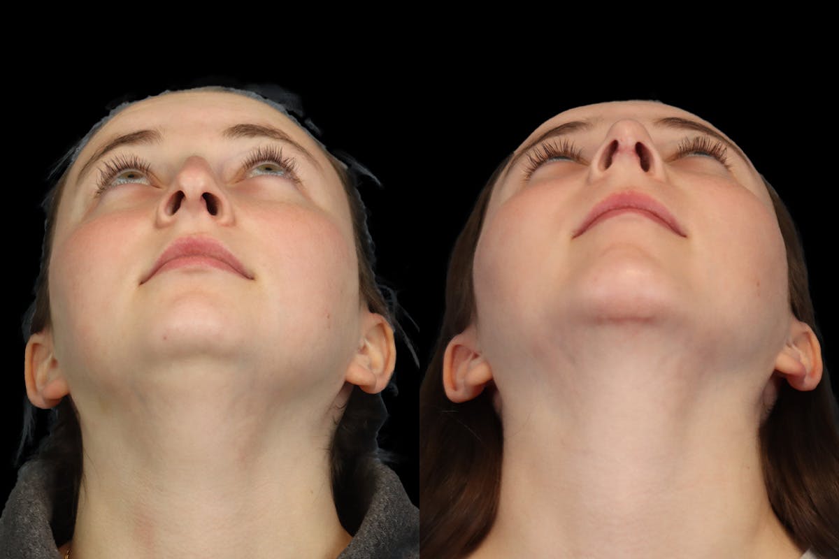 Nose Before and After | Leong Facial Plastic Surgery