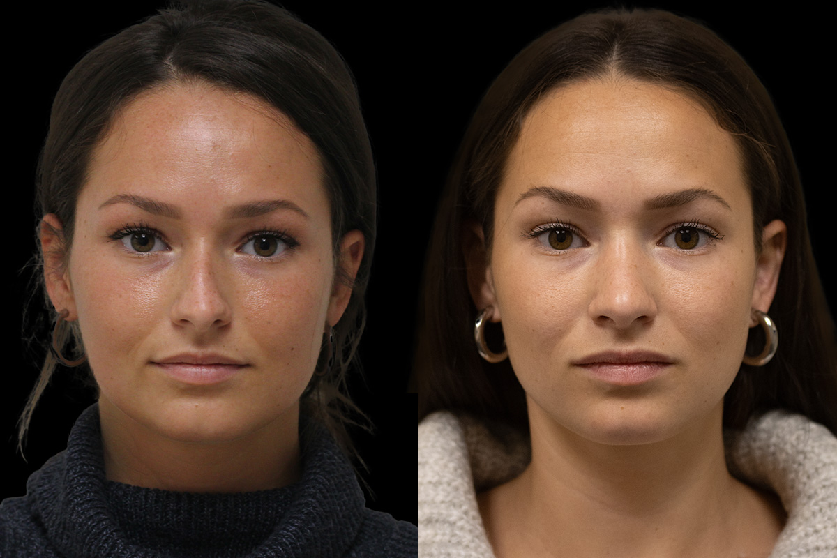 Nose Before and After | Leong Facial Plastic Surgery